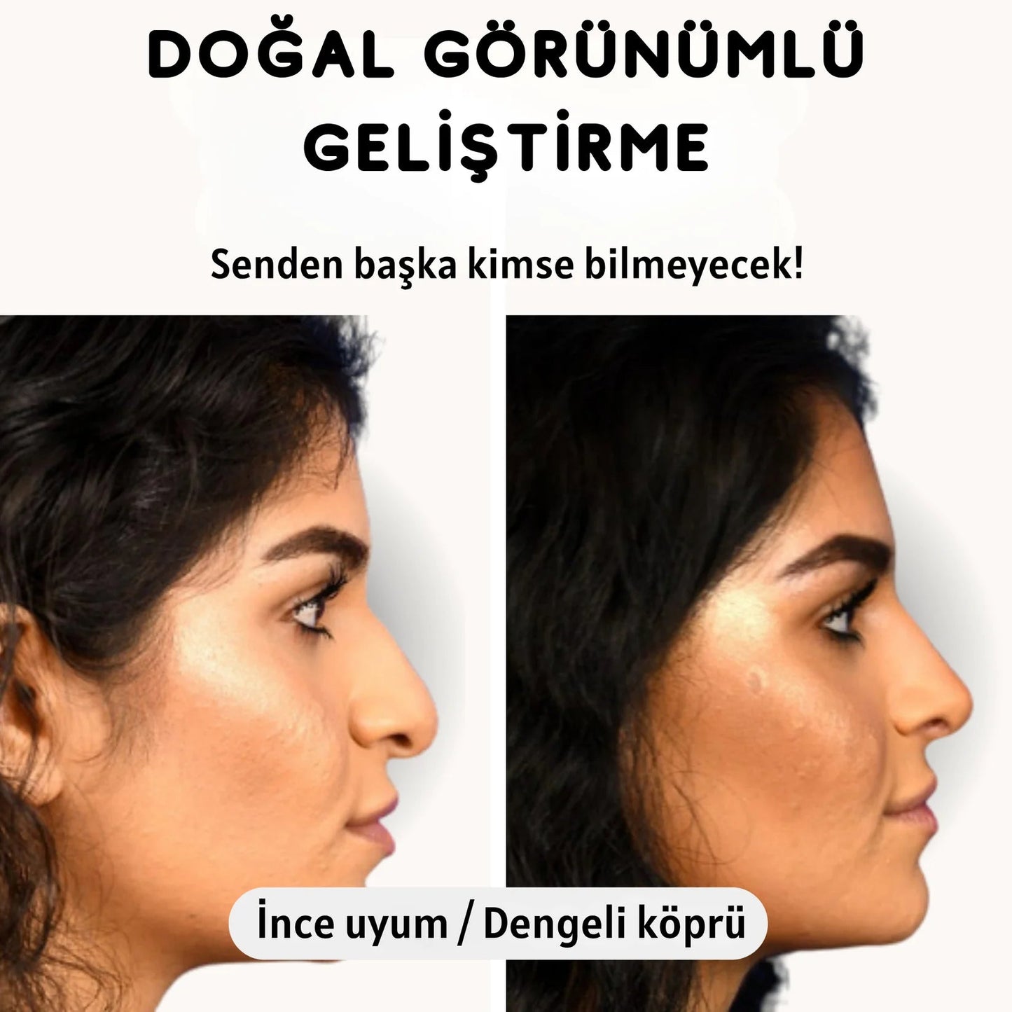 Burunest™ Noselift